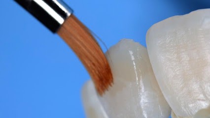 Dr Alix Devictor - Esthétique du sourire - Facette - Facettes pelliculaires - Implants dentaire - Greffe de gencive, Dentiste à Marseille 08